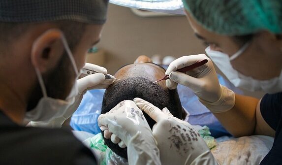 De nyeste fremskridt inden for hårtransplantationer for mænd
